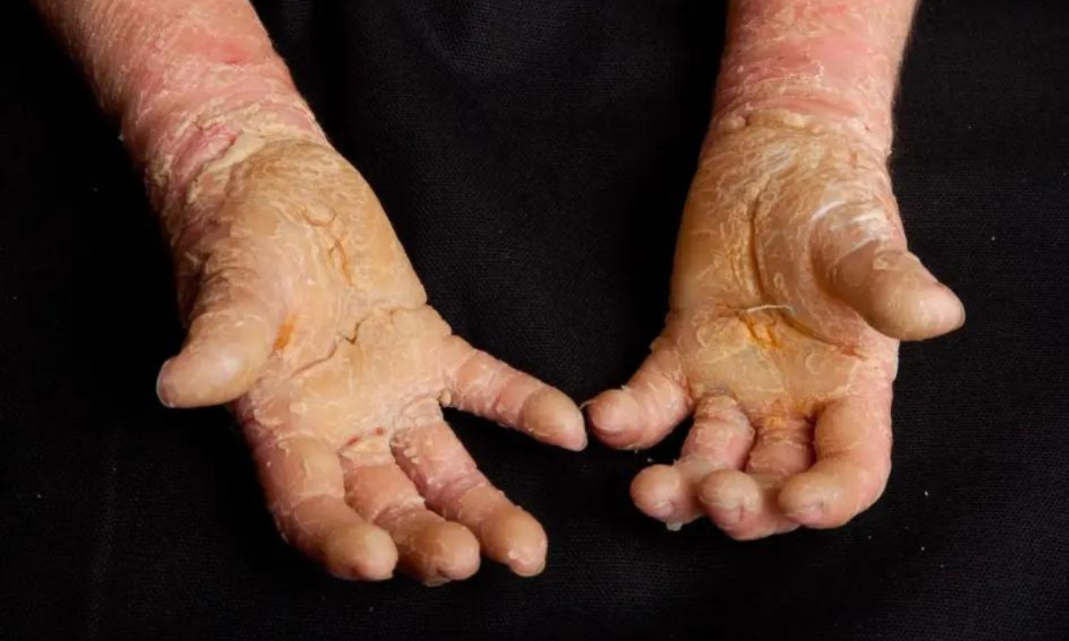The Rare Disease That Makes Skin Grow Too Fast Look Burnt
