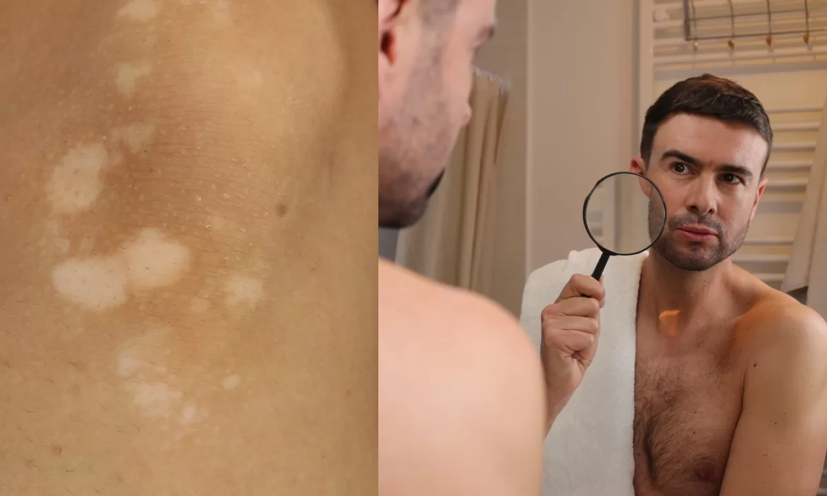 White spots on the skin: why do they appear and how to remove them?
