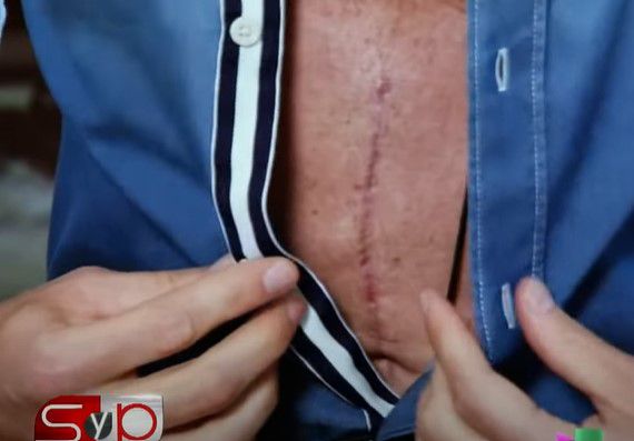 The wound was around 10 centimeters, through which they cleaned his intestines and closed the ulcer (Screenshot/YouTube)