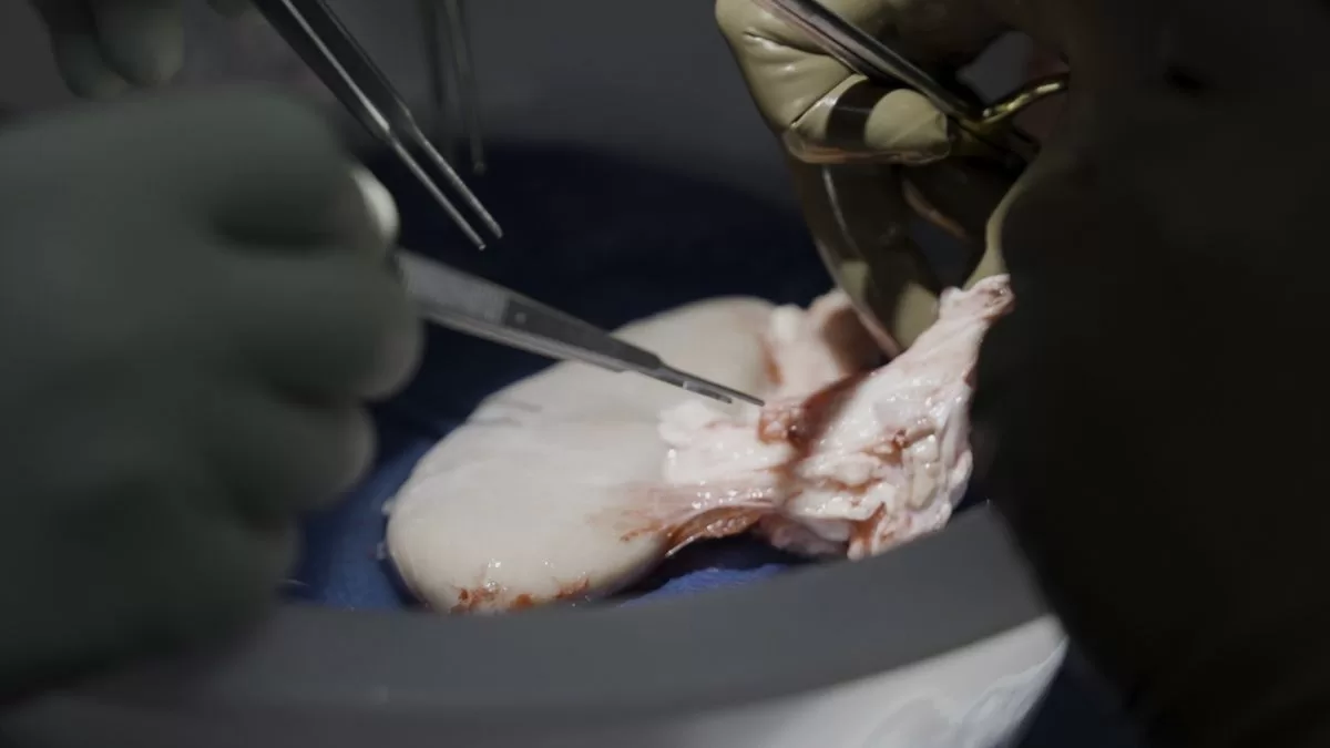 Brain-dead man successfully transplanted kidney from pig
