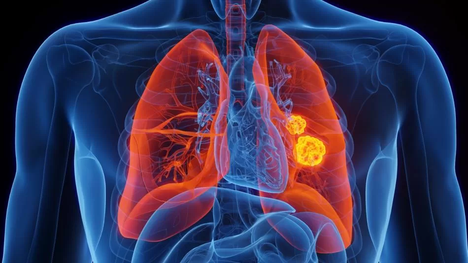 Lung Cancer Day: Early Diagnosis May Reduce Mortality Rate
