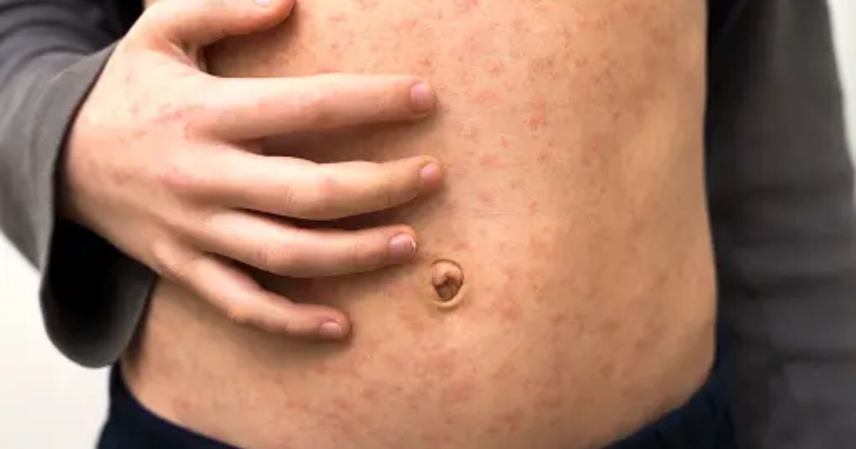 Measles infections in the US reach 125 cases in 2024

