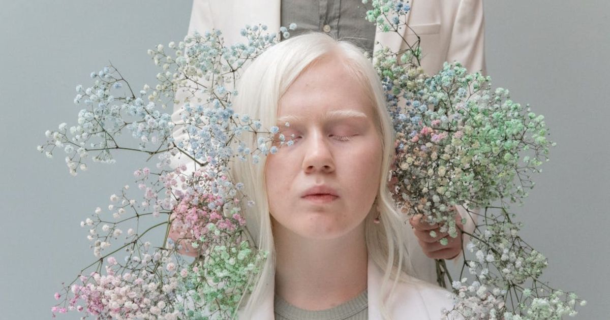One in every 17,000 people is albino in North America